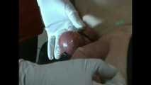 testicular needles